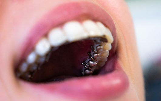 Hidden Braces