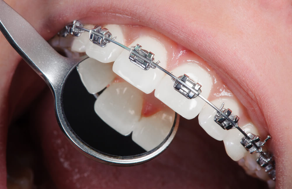 Metal Braces
