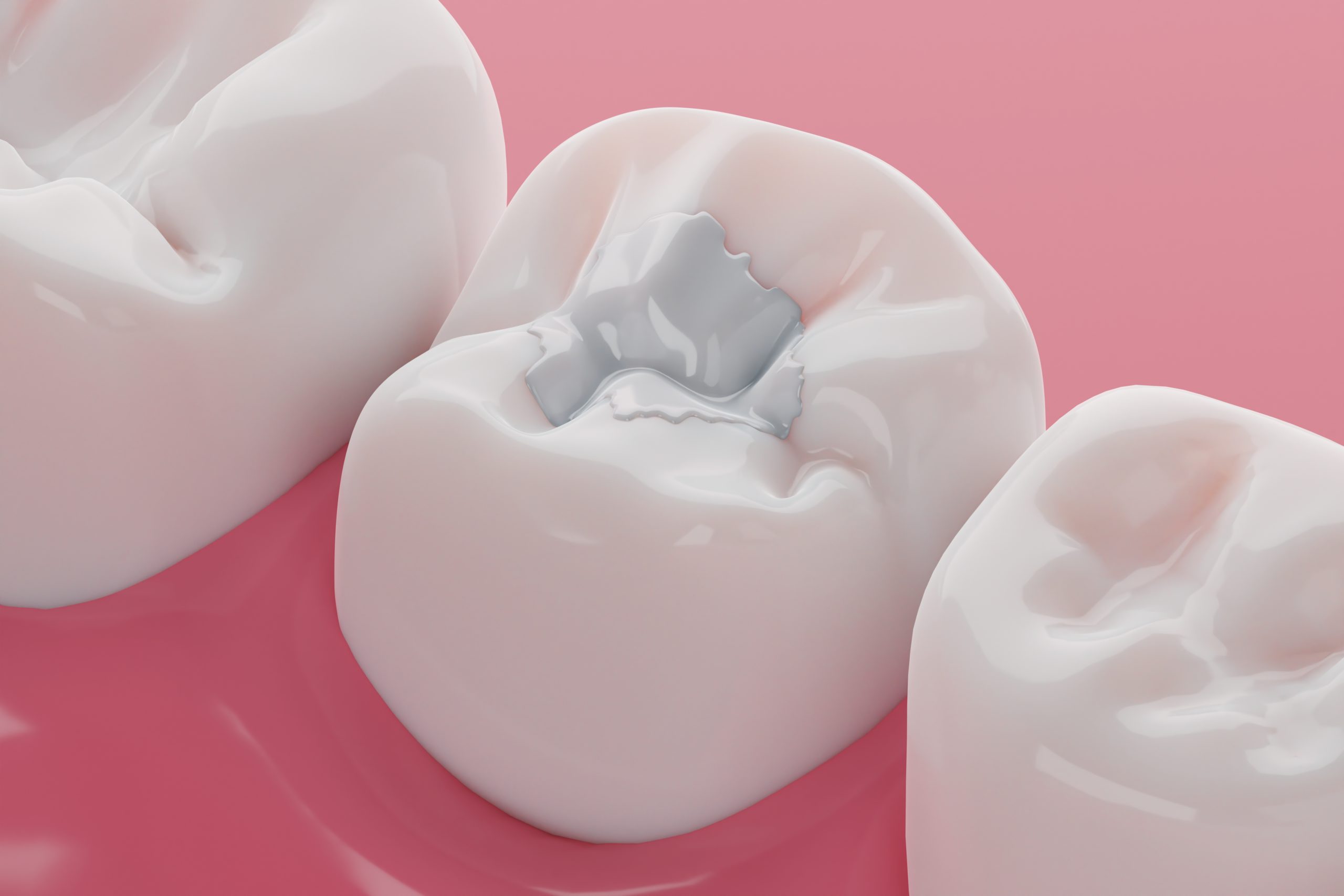 Tooth coloured fillings